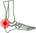 Achilles Tendinopathy