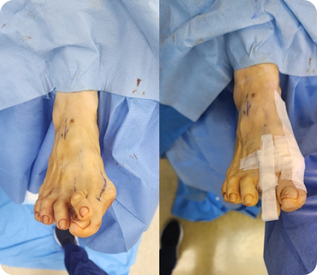 Understanding your bunions/hallux valgus deformity