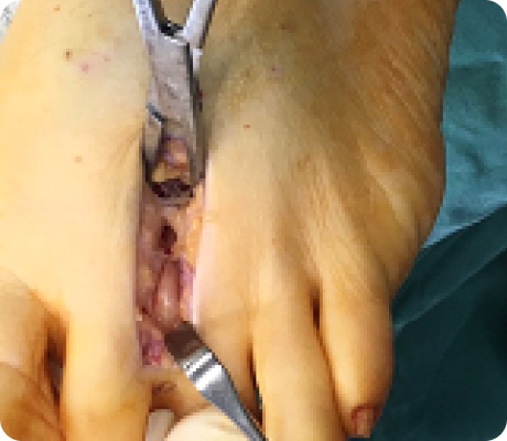 Understanding your bunions/hallux valgus deformity