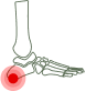 Surgery for Plantar Fasciitis