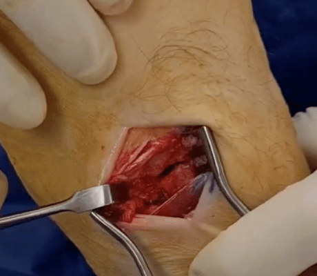 Understanding your bunions/hallux valgus deformity
